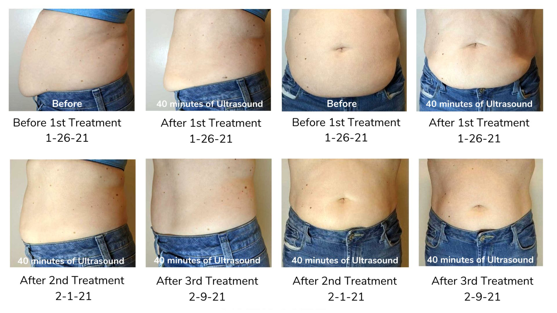 Waist before and after ultrasound body contouring, 1 session