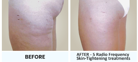 Thigh before and after 5 radio frequency skin-tightening treatments