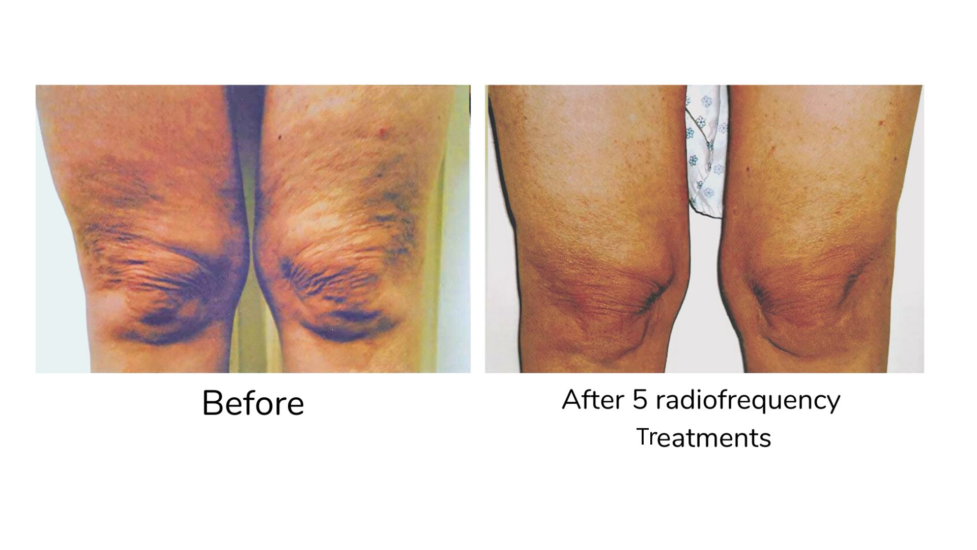 Knees before and after 5 radio frequency treatments